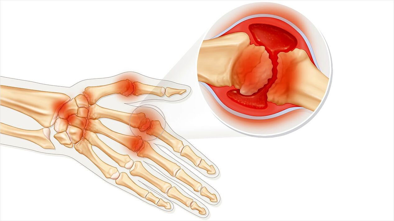 Osteoarthritis, die mit Traugel behandelt werden soll