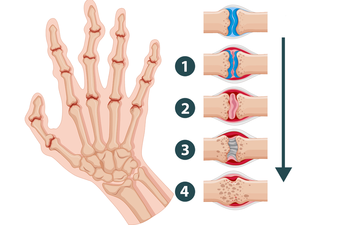 Entwicklungsstadien von Arthritis und entzündlichen Gelenkschäden. 