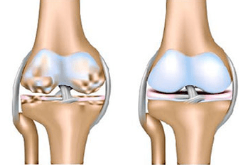 Gesunde Artikulation und Arthrose