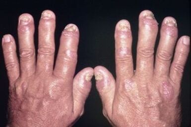 Warum die Fingerspitzen weh tun