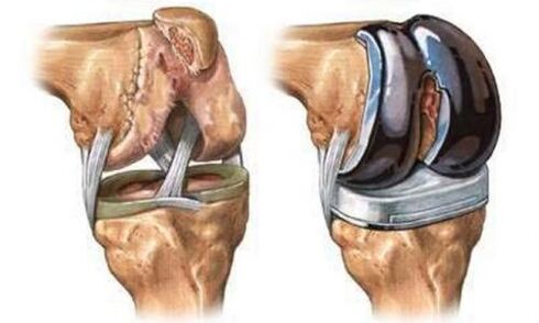 Endoprothetische Kniegelenk gegen Arthrose