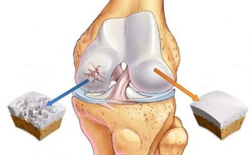 Gesunde Artikulation und Arthrose des Kniegelenks