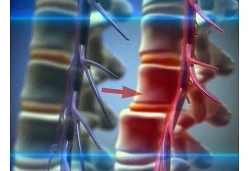 Kompression von Nervenenden bei lumbaler Osteochondrose.