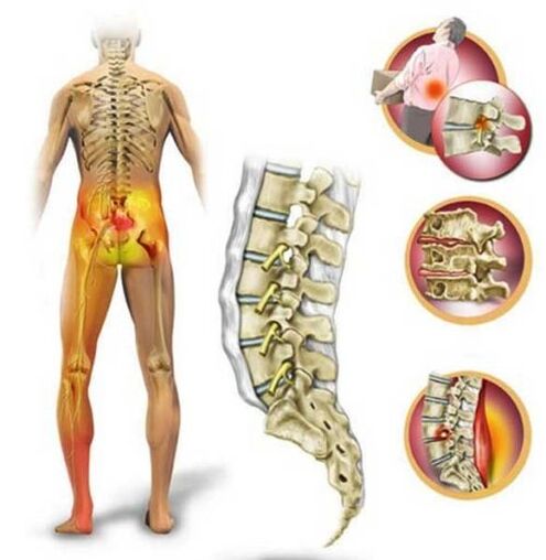 Osteochondrose der Lendenwirbelsäule, die Schmerzen im unteren Rückenbereich verursacht.