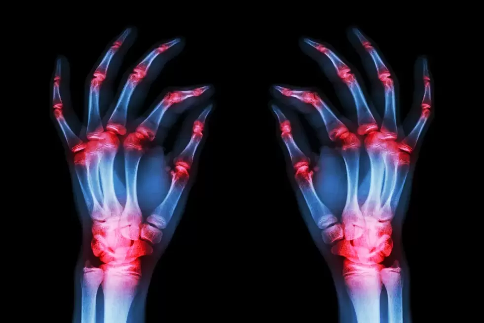 Arthrose der Fingergelenke