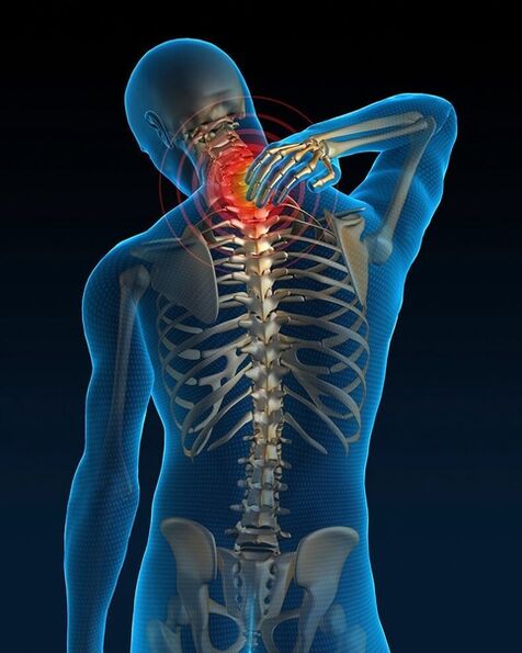 In der Anfangsphase der Behandlung der zervikalen Osteochondrose nehmen die Schmerzen im Nacken zu. 