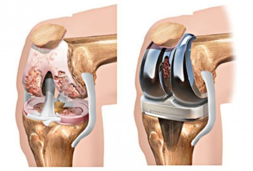 Knieendoprothetik bei Arthrose