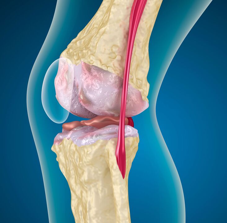 Arthrose des Kniegelenks eine degenerative dystrophische Erkrankung