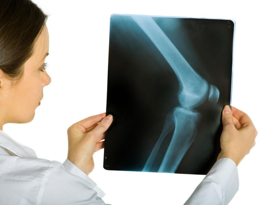 Eine Röntgenaufnahme des Kniegelenks zeigt das Vorhandensein einer deformierenden Osteoarthritis. 